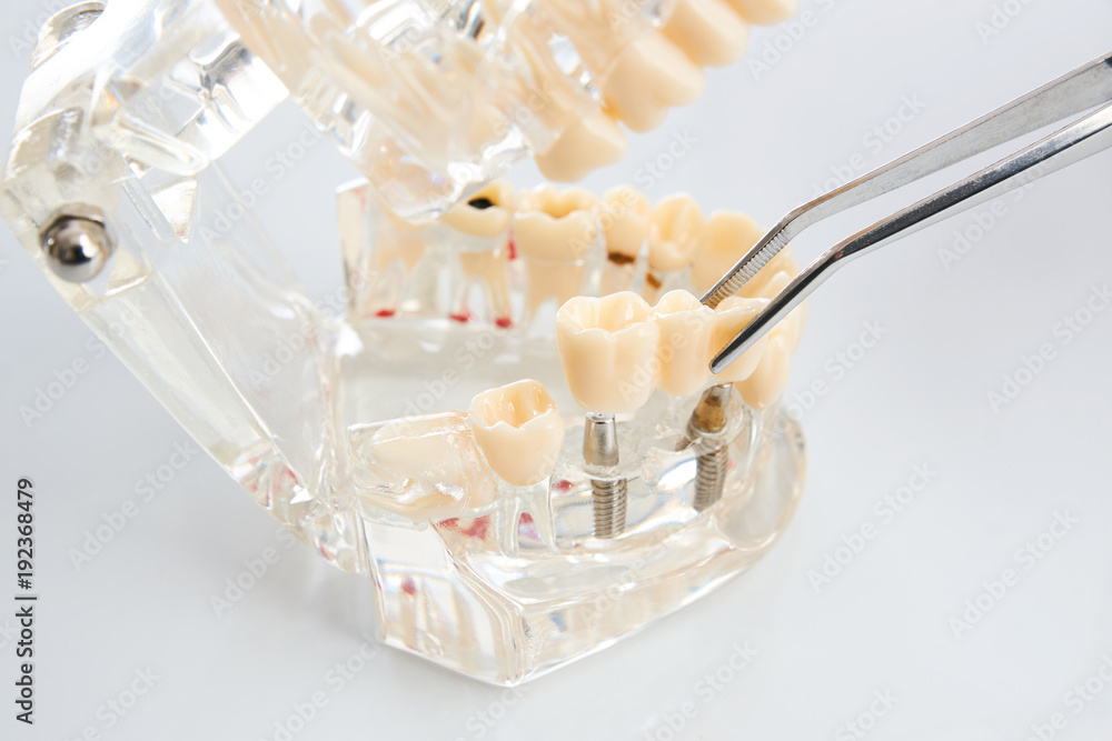 Dental technician placing the fixed partial denture, dental bridge on
