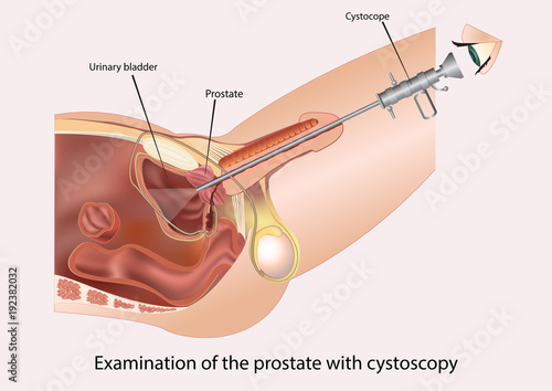 Examination of the prostate with cystoscopy