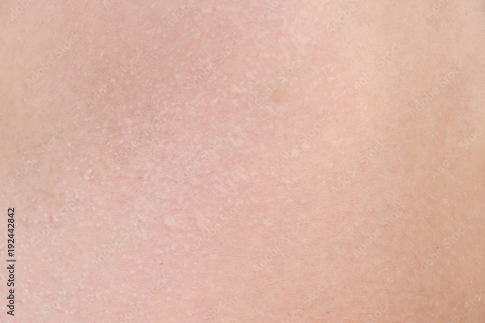 burnt skin sunburn a great extent, the sun, many small blisters closeup burnt skin sunburn a great extent, the sun, many small blisters closeup