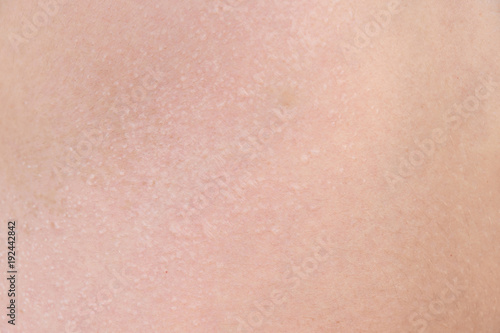 burnt skin sunburn a great extent, the sun, many small blisters closeup