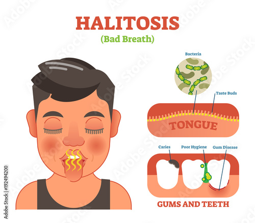 Halitosis. Bad breath vector illustration diagram poster.
