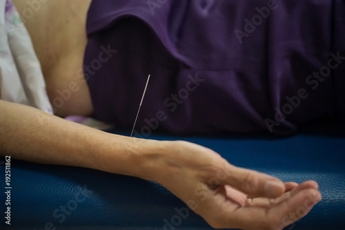 Closeup of the hand stimulation acupuncture therapy.