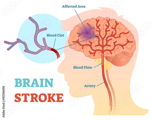Brain Stroke anatomical vector illustration diagram, scheme 
