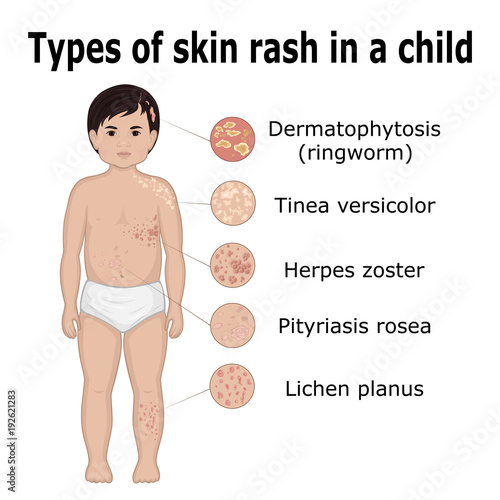 Types of skin rash in a child
