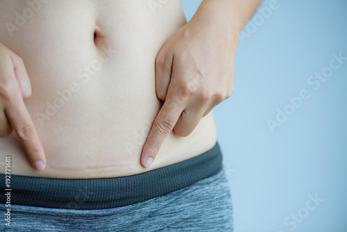 Closeup of woman showing on her belly dark scar from a cesarean section.