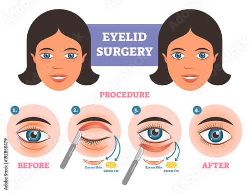 Eyelid surgery procedure before  after illuatration with main steps. Excess skin and fat removal.