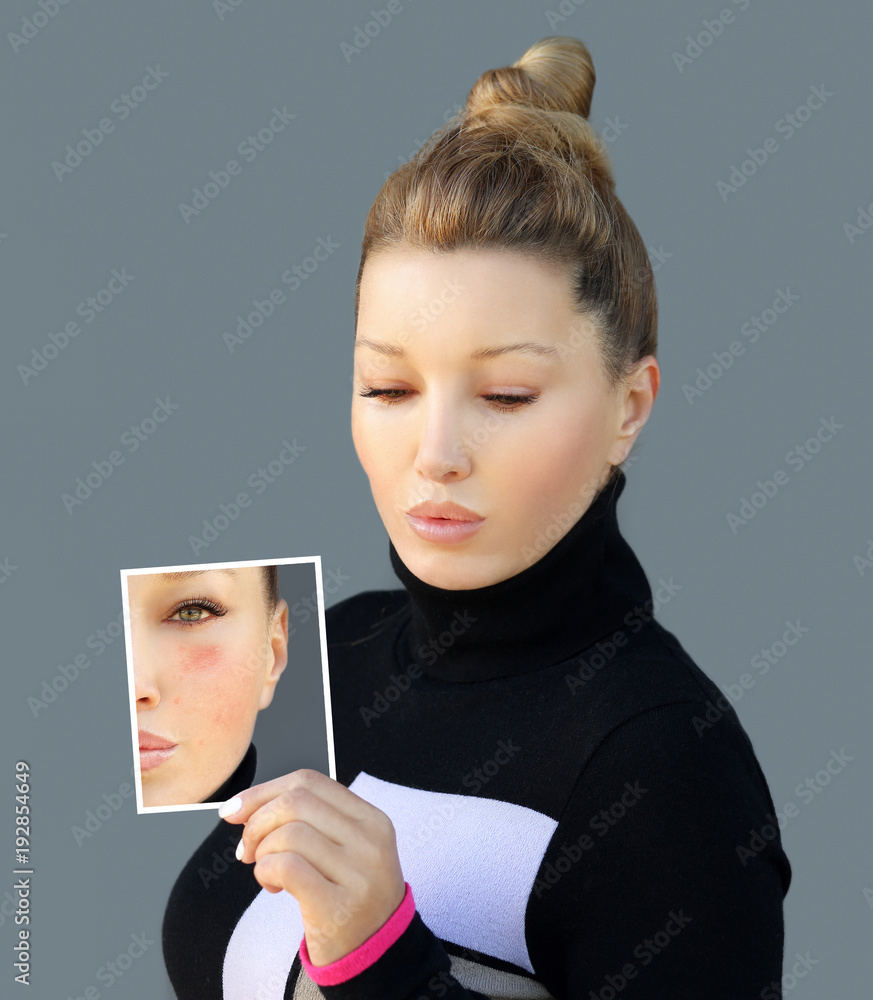 Acne Post Acne Marks Treating Acne Scars Stock Photo Adobe Stock acne-post-acne-marks-treating-acne-scars-stock-photo-adobe-stock