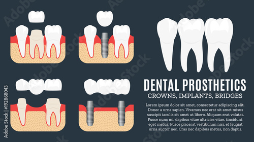 Dental prosthetics illustration