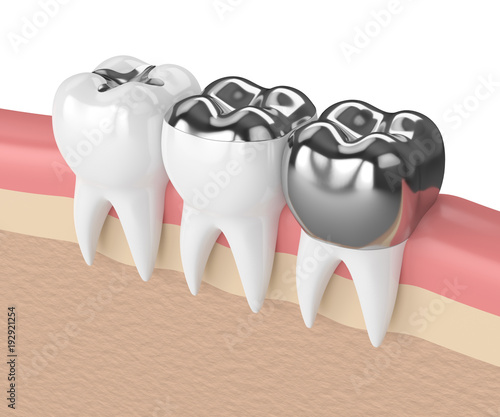 Fotografie 3d render of teeth with different types of dental amalgam filling