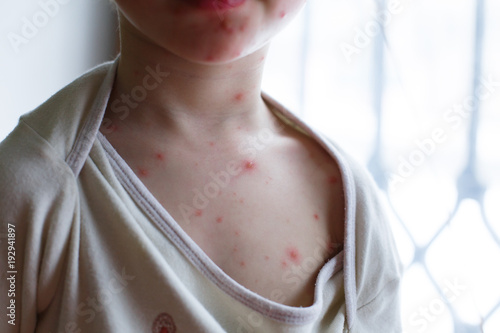 Baby with chicken pox rash. Varicella virus or Chickenpox bubble rash on child. Dermatology concept photo