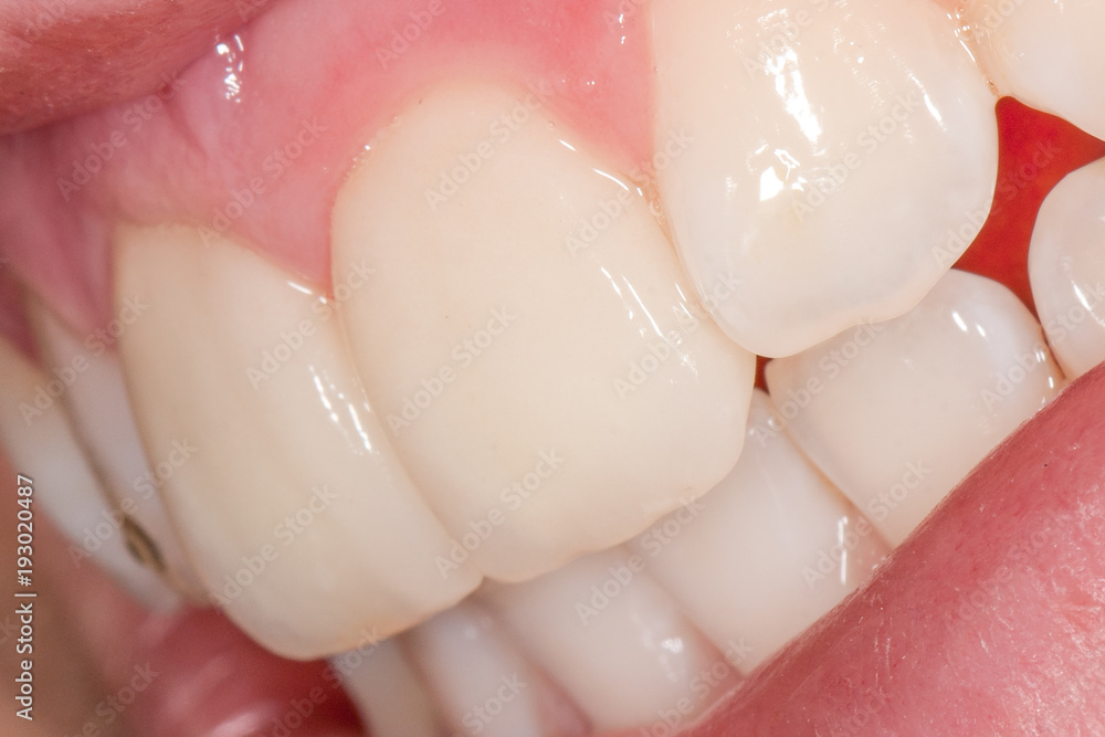 Fototapeta premium Veneers auf Schneidezähnen