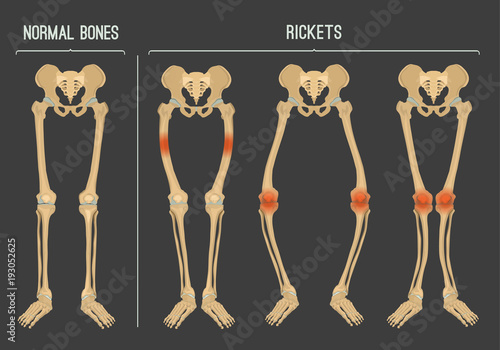 Vector Rickets Scheme