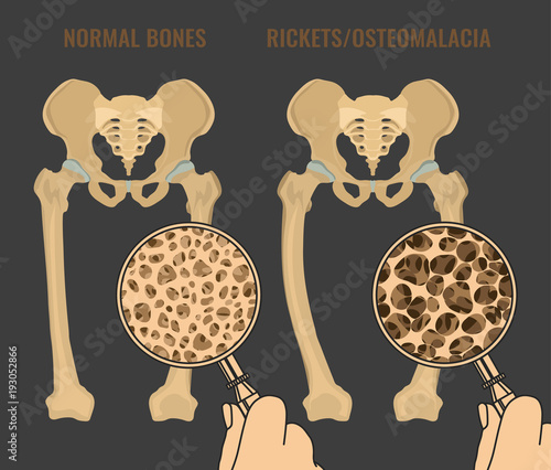 Vector Rickets Scheme photo