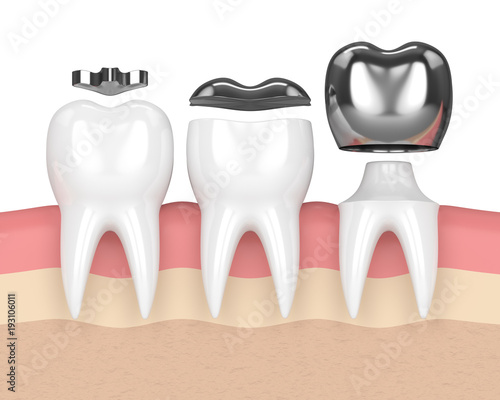 Fototapeta Naklejka Na Ścianę i Meble -  3d render of teeth with different types of dental amalgam filling