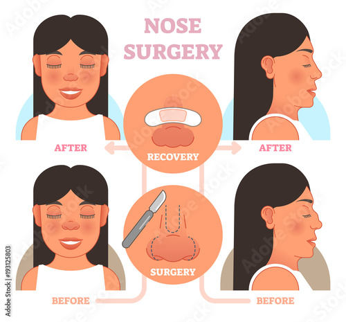 Nose plastic surgery vector illustration.