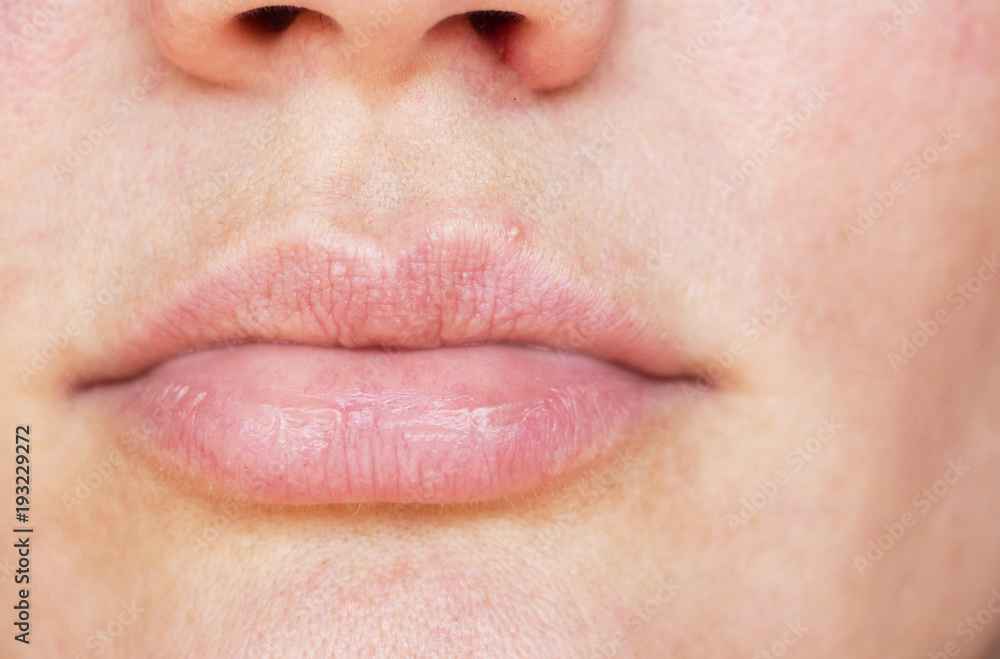 pimples on the lips pimples on the lips