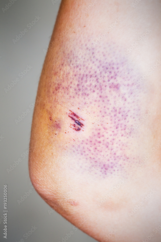 Fototapeta premium Bruise on the skin