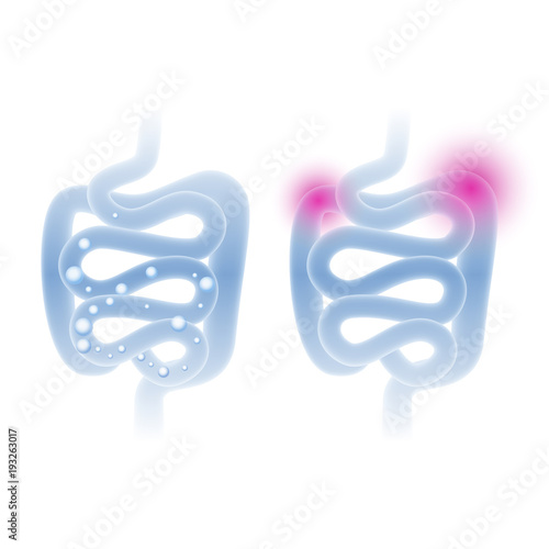 Abstract medical vector illustration of healthy and sick intestine in a light blue color