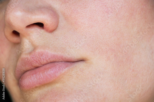 acne on the face. pores on the face