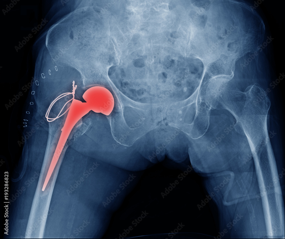 xray image hip replacement, Total hip arthroplasty Stock Photo Adobe
