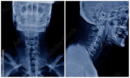 cervical spine spondylosis, x-ray c-spine show degenerative change and loss space of nerve root foramen photo