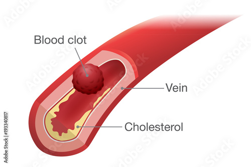 Blood clot occurs in a vein. Illustration about health problem and medical.