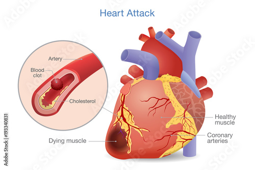 Illustration of Arterial thrombosis is a blood clot that develops to heart attack. Causes and risk factors for health problem.