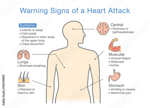 Diagram about warning signs of a heart attack. Illustration about medical diagram for diagnose a disease or condition.
