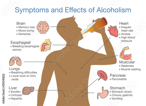 Symptoms and effects of alcoholism patient. Illustration about health problem of people with alcohol addiction.