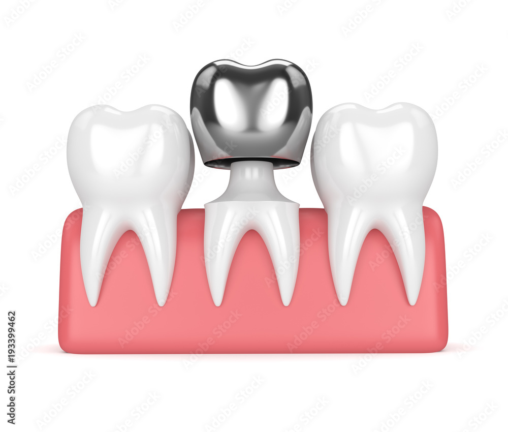 3d render of teeth with dental crown amalgam filling 3d render of teeth with dental crown amalgam filling
