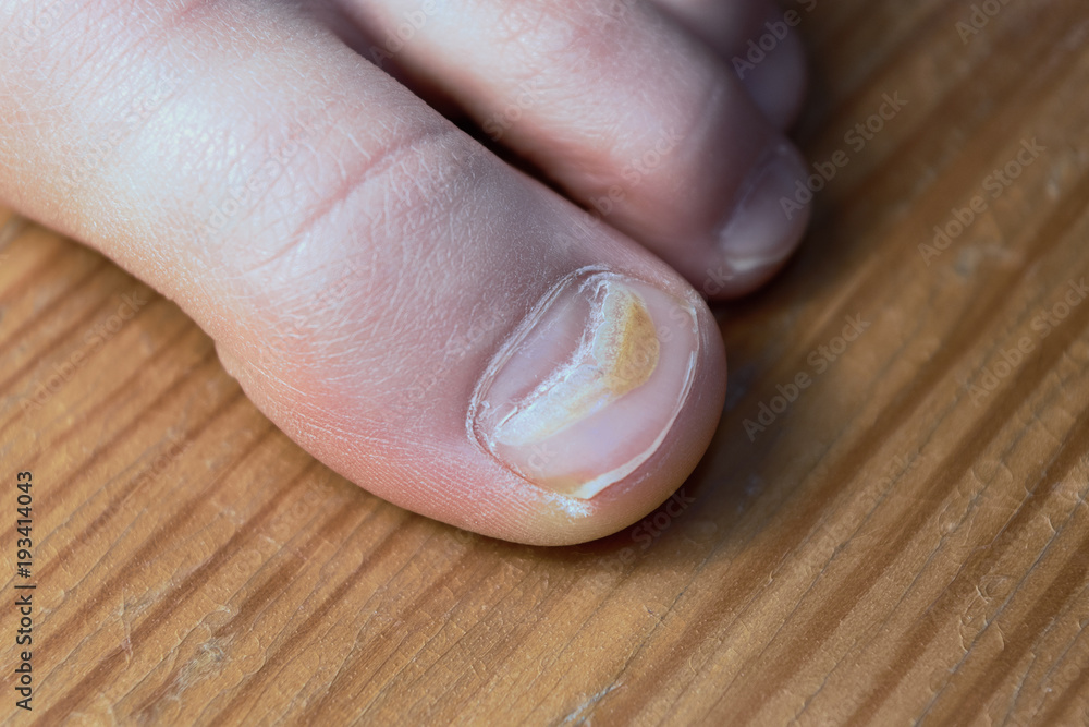 Effects of enterovirus on the body in the form of damage to the thumb. His  fingernails became uneven and cracked. The right view. Human health and  medicine. Stock Photo | Adobe Stock