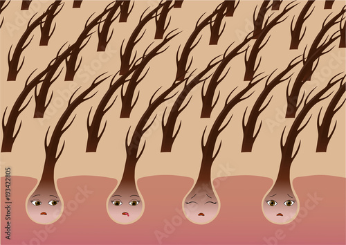 Cartoon hair follicles on the scalp suffer from dryness