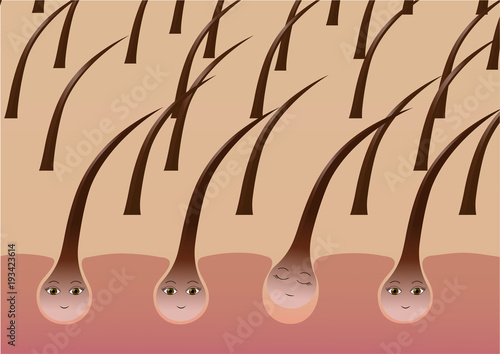 Cartoon hair follicles on the scalp suffer from loss