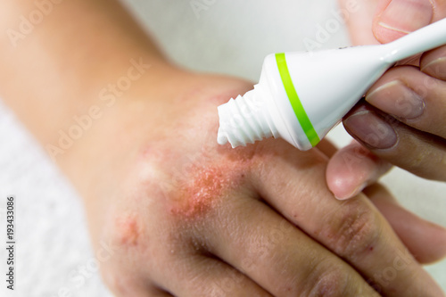 Ointment on hand. Applying the ointment in the treatment and hydration of the skin. photo