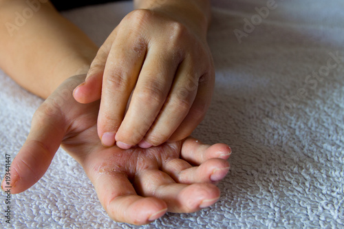 Eczema on the hands . Skin disease causing itching . Woman's hands scratching with eczema