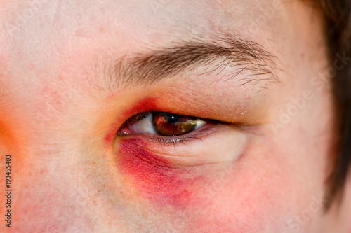 Eye injury, male with black eye isolated on white. man after accident or fight .