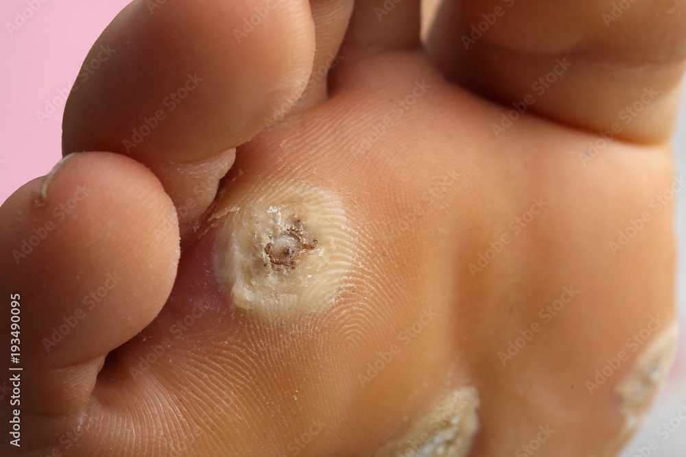 Warts on the leg on a young girl . Warts on the leg on a young girl .