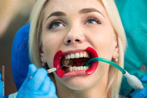 Obraz na plátne Close up of female mouth with retractor and composite use for whitening the teeth in dental office
