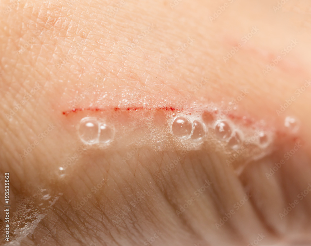 Fototapeta premium a scratch on the arm