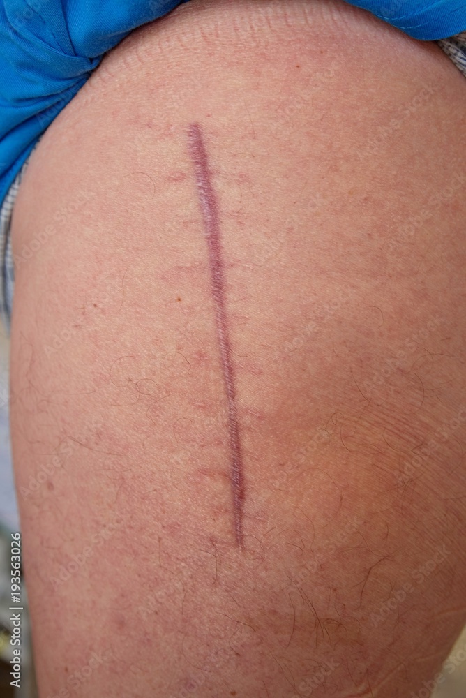 One year old scar following surgery of hip joint. Replacing of the