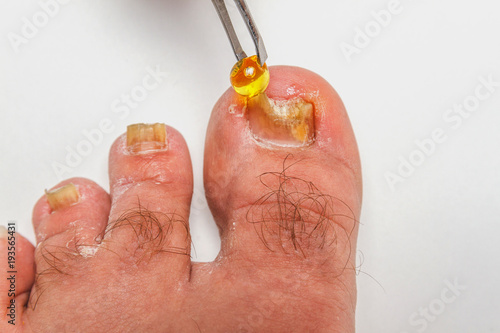 A toenail fungus