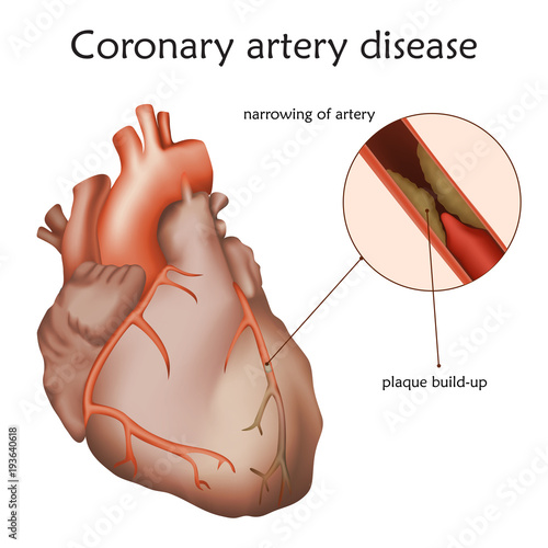 Coronary artery disease. Blocked artery, damaged heart muscle. Anatomy illustration. Colorful image, white background.