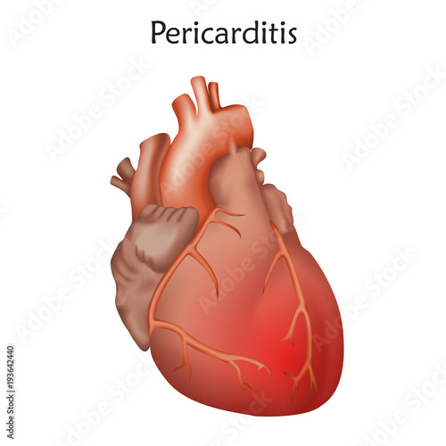 Pericarditis. Inflammation of the pericardium. Damaged heart muscle. Anatomy illustration. Colorful image, white background.