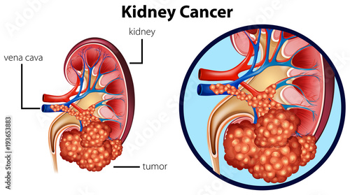 Diagram showing kidney cancer