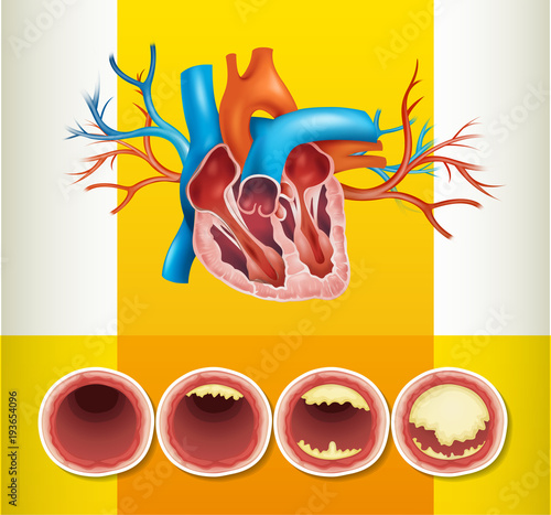Heart anatomy and fat in vein