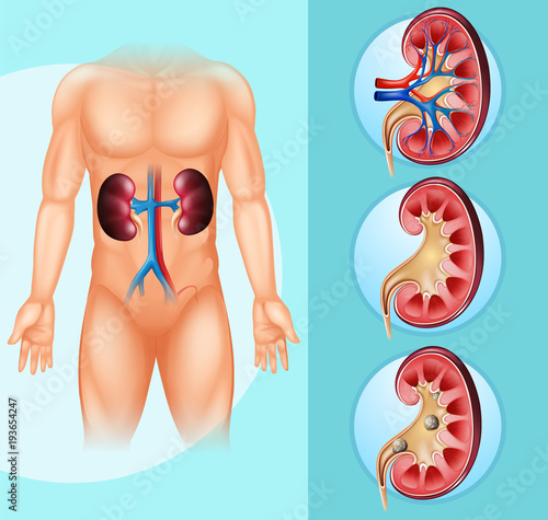 Human and kidney stones