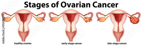 Diagram showing stages of ovarian cancer