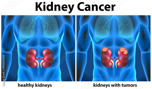 Diagram showing kidney cancer in human