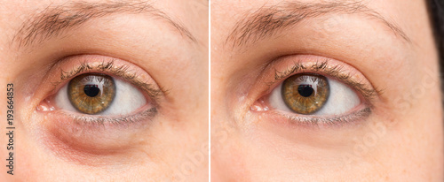 Tableau sur toile Puffy eye before and after beauty treatment