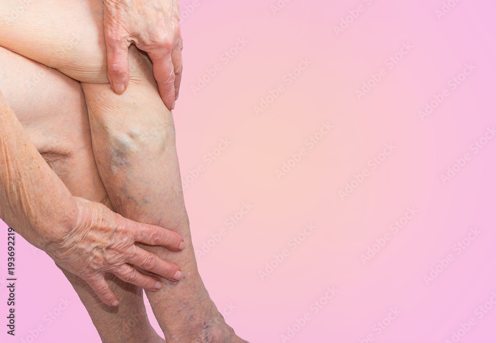 Naklejka premium The varicose veins on a legs of old woman on blue